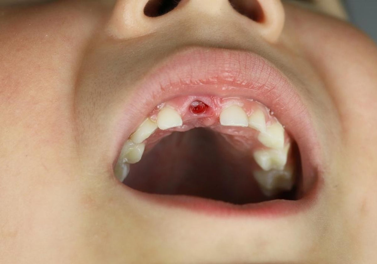 sonar que se te caen los dientes de abajo mal augurio
