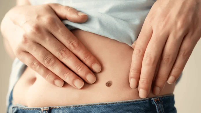 Aumento de cáncer de piel en RD
