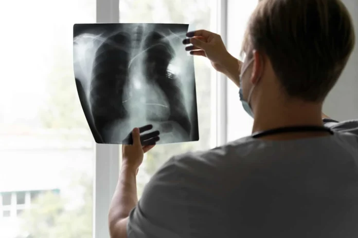 Broncoscopia robótica para diagnóstico de cáncer.