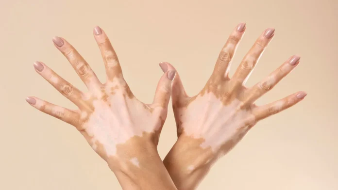 Promoción de inclusión en vitiligo